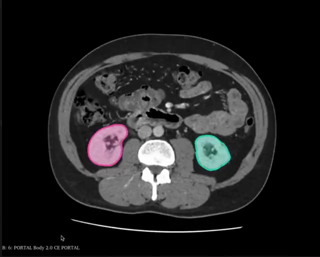 Segmentação de CT Renal